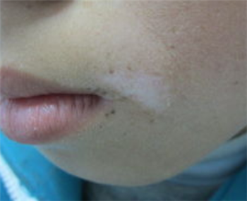 应该怎样防止白癜风扩散