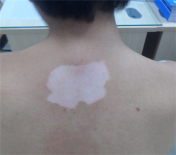 白癜风要是扩散了该怎么办