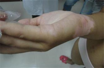 白癜风早期出现的症状是什么样的