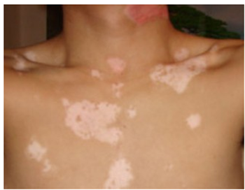 节段型白癜风的治疗该怎么办