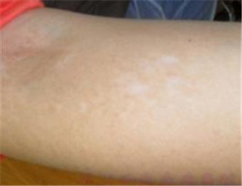 怎样可以有效的防止白癜风复发