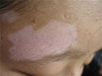 白癜风是不是属于治不好的病?(图1)