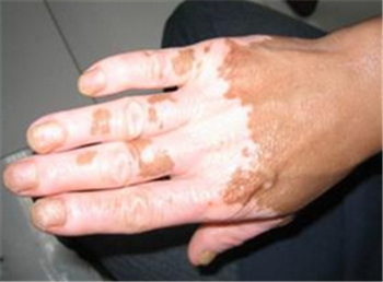 白癜风应该怎么防止扩散