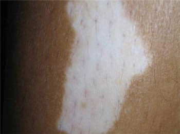 白癜风有多大的危害你知道吗?(图1) 白癜风有多大的危害你知道吗