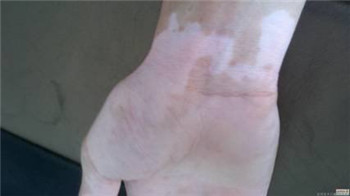 白癜风早期的症状表现是什么样的？(图1)