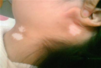 儿童白癜风有哪些治疗方法?(图1) 儿童白癜风有哪些治疗方法