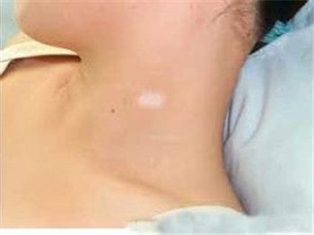 女性患者应怎样治疗白癜风?(图1) 女性患者应怎样治疗白癜风