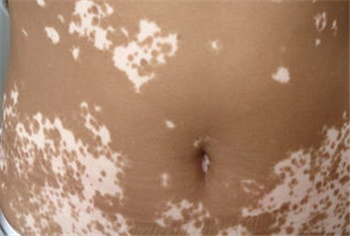 成人要怎样防止白癜风发生?(图1) 成人要怎样防止白癜风发生?(图1)