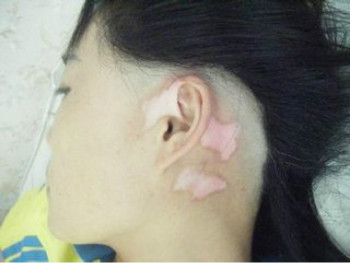 避免紫外线照射为什么对预防白癜风有帮助?(图1)