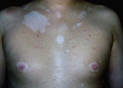 白癜风容易泛发的季节你知道吗?(图1)