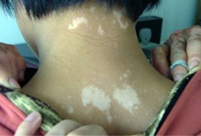 预防儿童白癜风该怎么做
