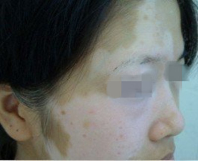 女性白癜风怎么治疗呢?(图1) 女性白癜风怎么治疗呢