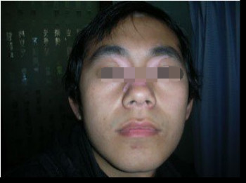 白癜风的发病具体是有哪些因素