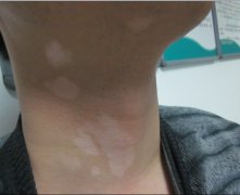 为什么白癜风的治疗效果一直不怎么好