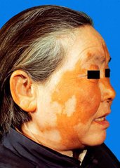 中老年人群会患上白癜风疾病的原因是什么呢?(图1) 中老年人群会患上白癜风疾病的原因是什么呢