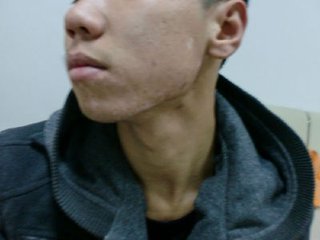 白癜风出现的早期是什么样的表现？(图1)